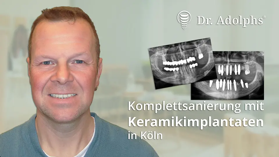 Behandlungsbeispiel Komplettsanierung mit Keramikimplantaten in Köln