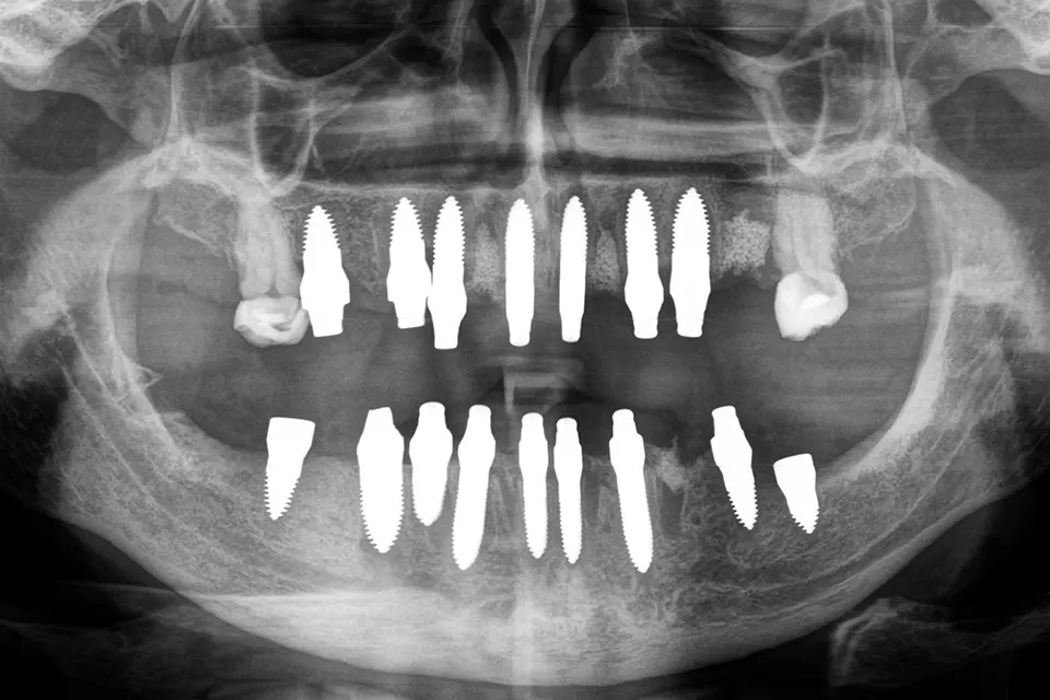 Röntgenaufnahme nach Setzen von 16 Keramikimplantaten