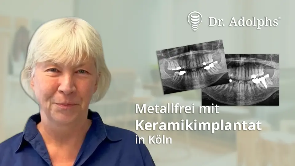Behandlungsbeispiel von Dr. Adolphs in der Zahnarztpraxis in Köln