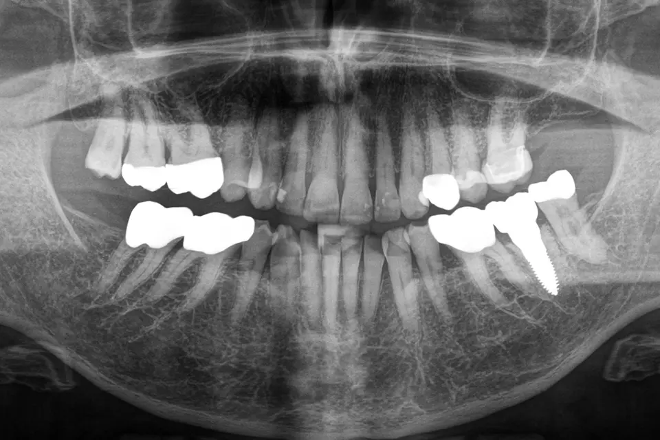 Röntenaufnahme des Kiefers nach Einsetzen des Keramikimplantats