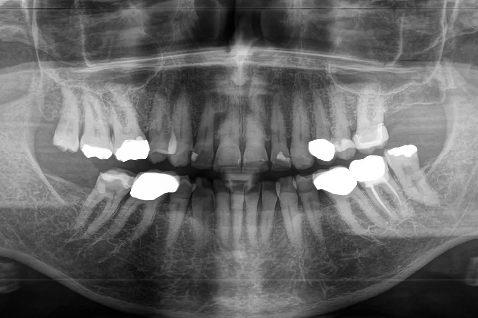 Röntenaufnahme des Kiefers vor Einsetzen des Keramikimplantats