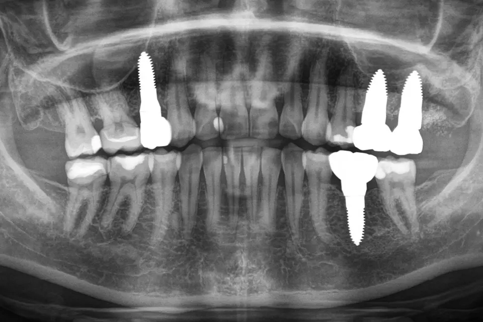 Röntenaufnahme des Kiefers nach Einsetzen des Keramikimplantats