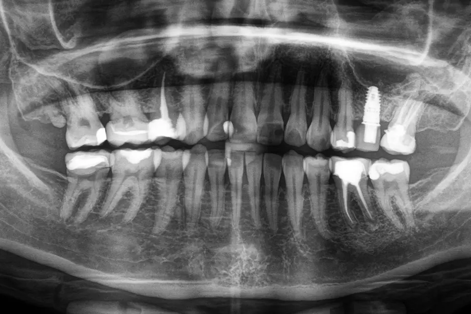 Röntenaufnahme des Kiefers vor Einsetzen des Keramikimplantats